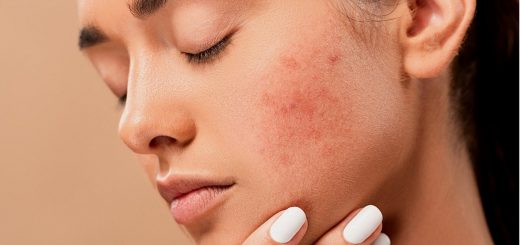 Acne Pimples Spots Zits Skin  - jmexclusives / Pixabay