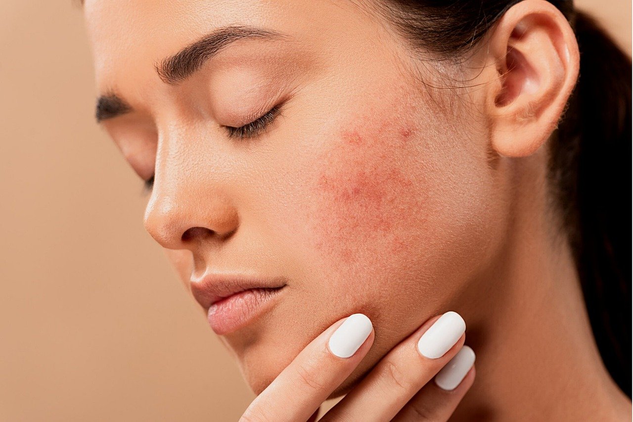 Acne Pimples Spots Zits Skin  - jmexclusives / Pixabay