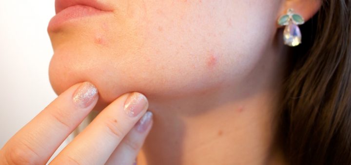 Acne Pores Skin Pimple Female  - Kjerstin_Michaela / Pixabay