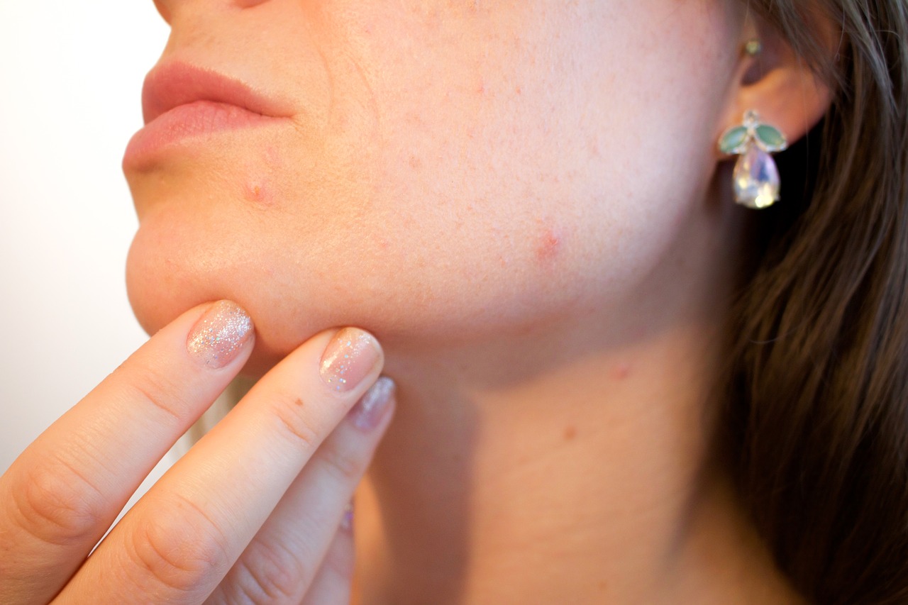 Acne Pores Skin Pimple Female  - Kjerstin_Michaela / Pixabay